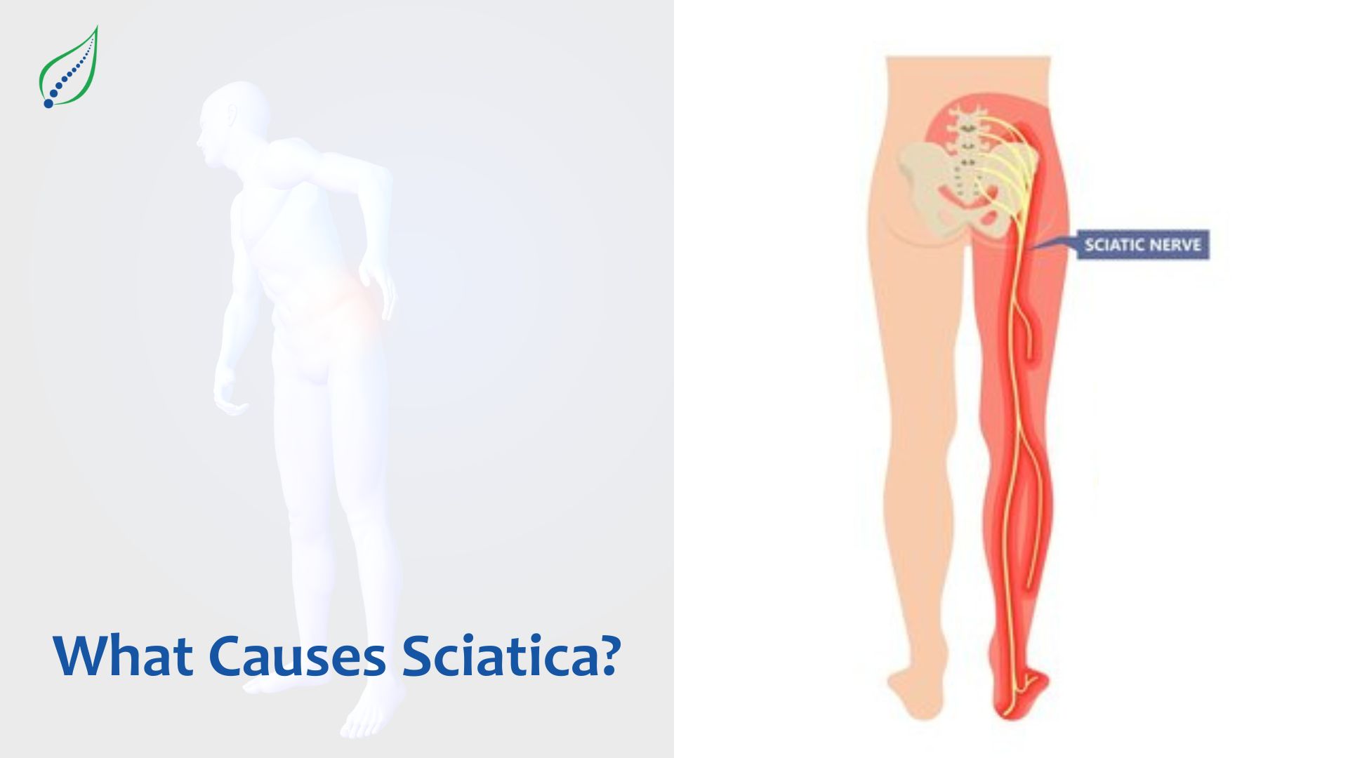 What Causes Sciatica?